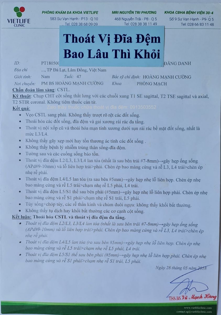 Thoát vị đĩa đệm bao lâu thì khỏi